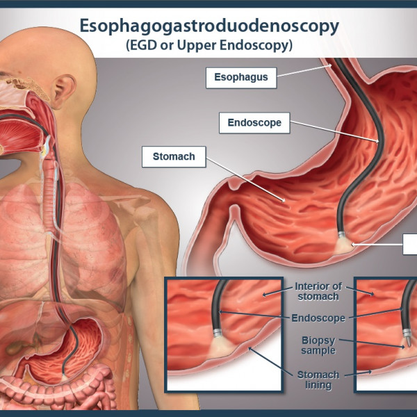 What Is The Difference Between Upper Gi And Egd