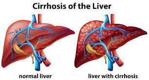 Life of a person living with Cirrhosis