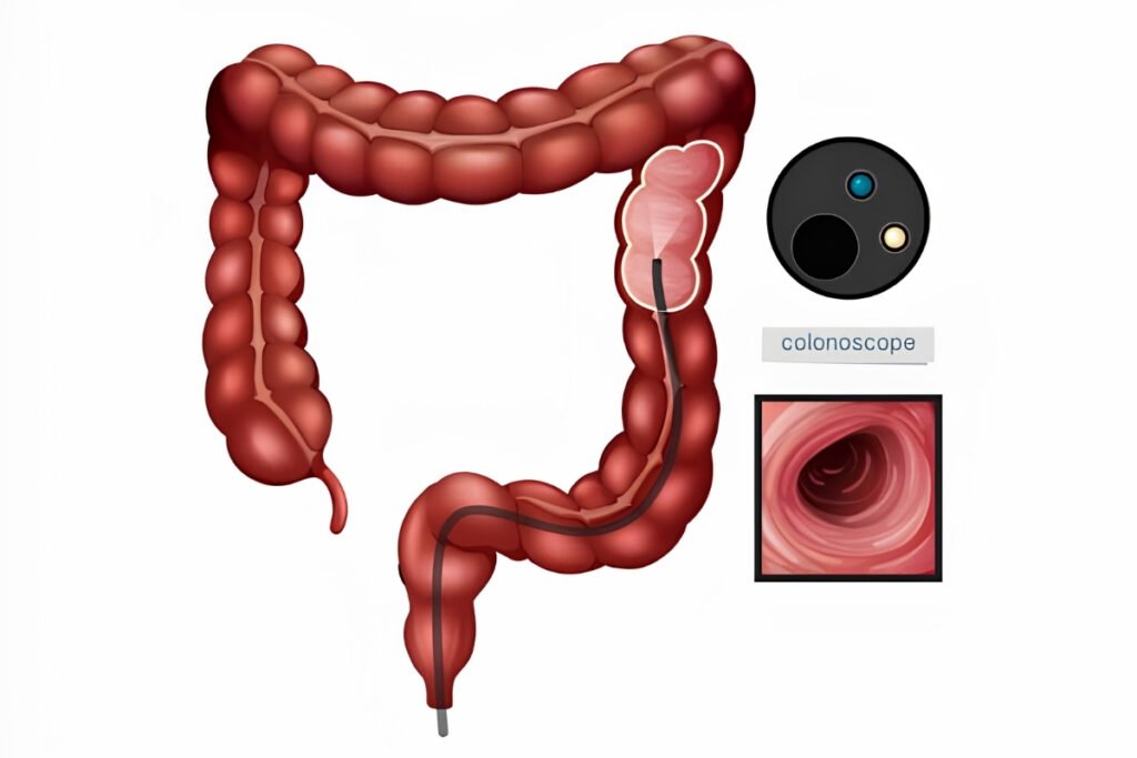 Ileo-Colonoscopy in Mumbai