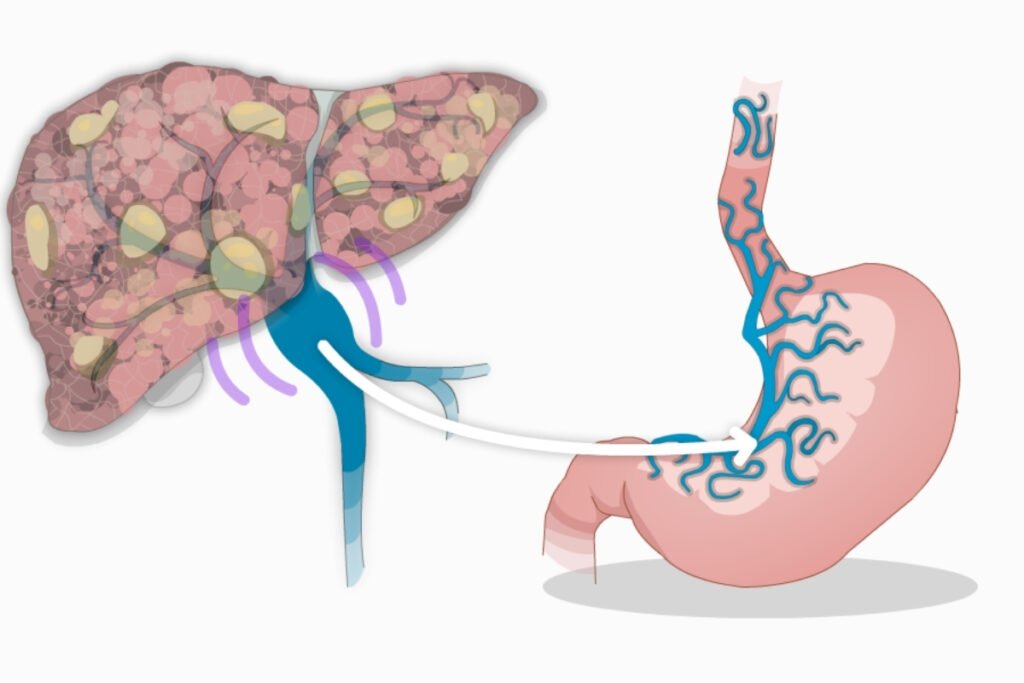 Portal Hypertension in Mumbai