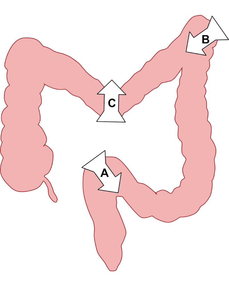 Ileo-Colonoscopy in Mumbai