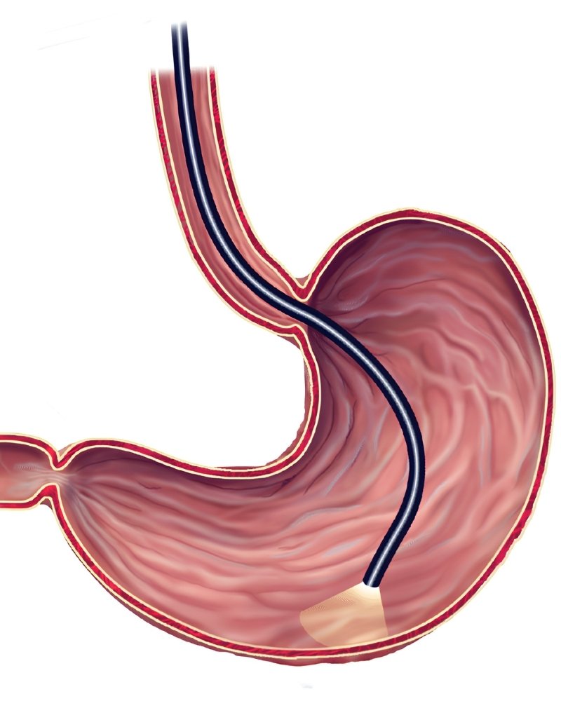Upper GI Endoscopy in Mumbai