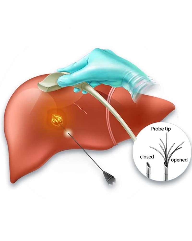 Radio Frequency Ablation in Mumbai