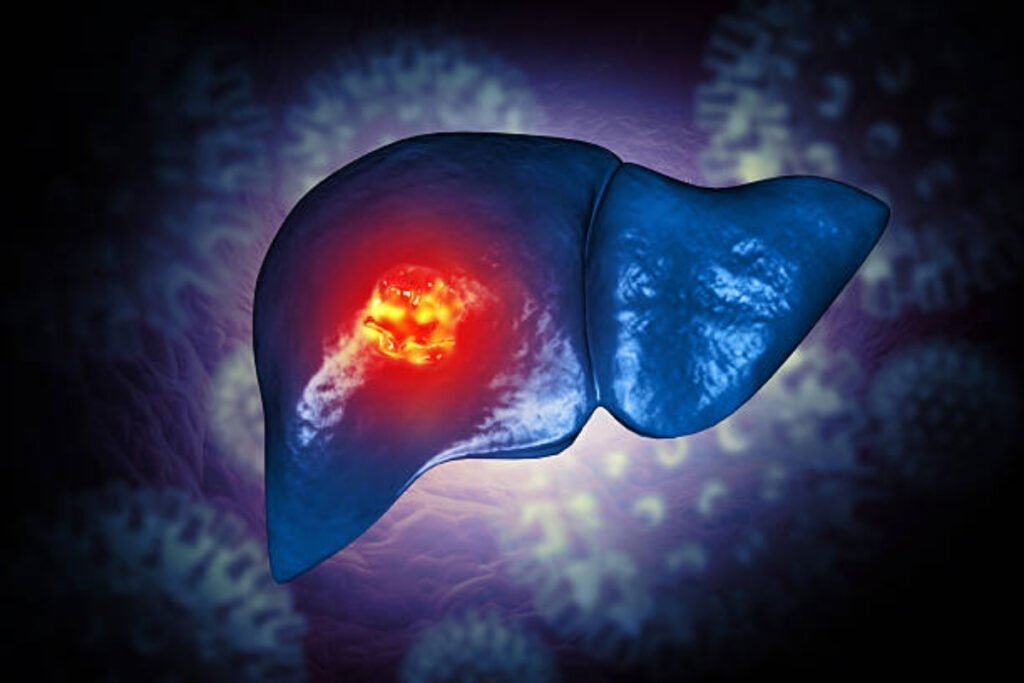 Liver cancer Treatment