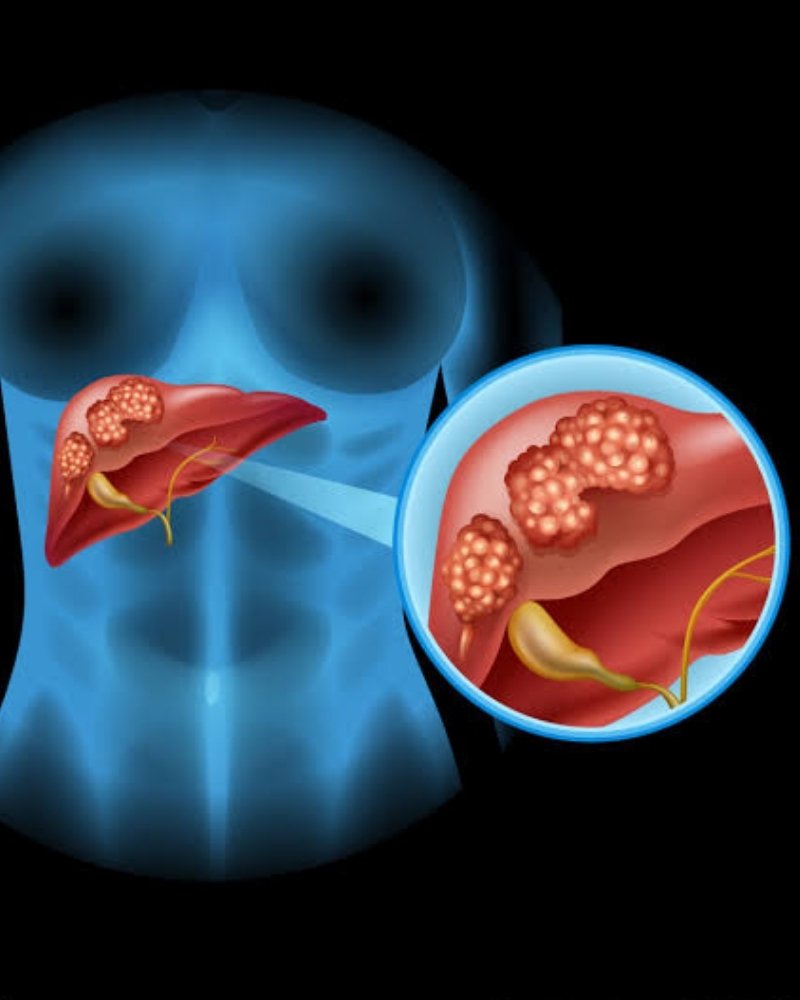 Liver Cancer Surgery in Mumbai