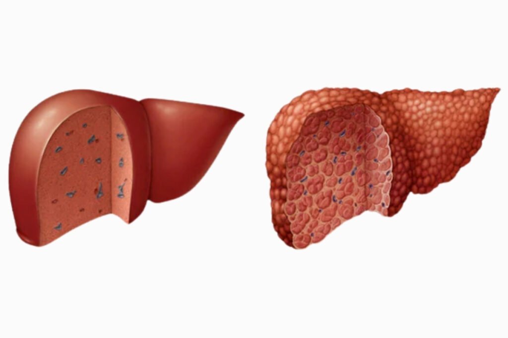 Wilson’s Disease