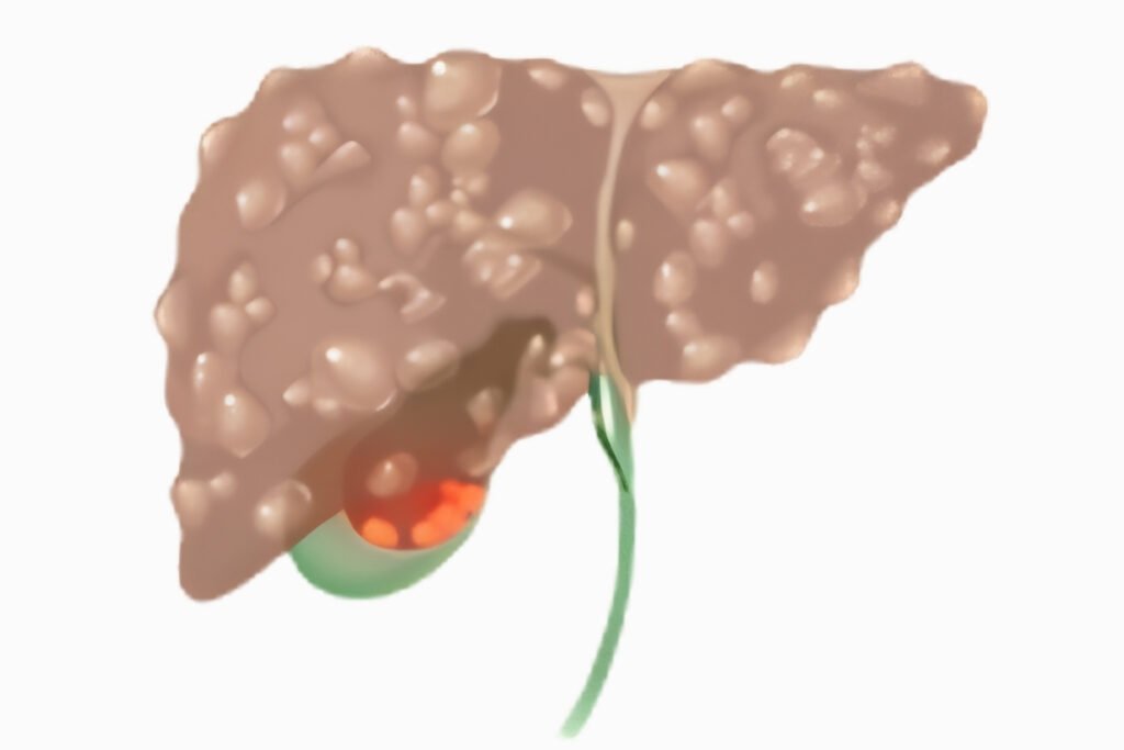 Primary Sclerosing Cholangitis (PSC)