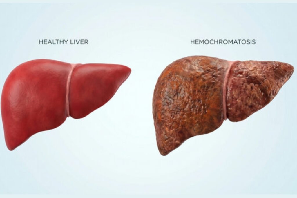 Hemochromatosis
